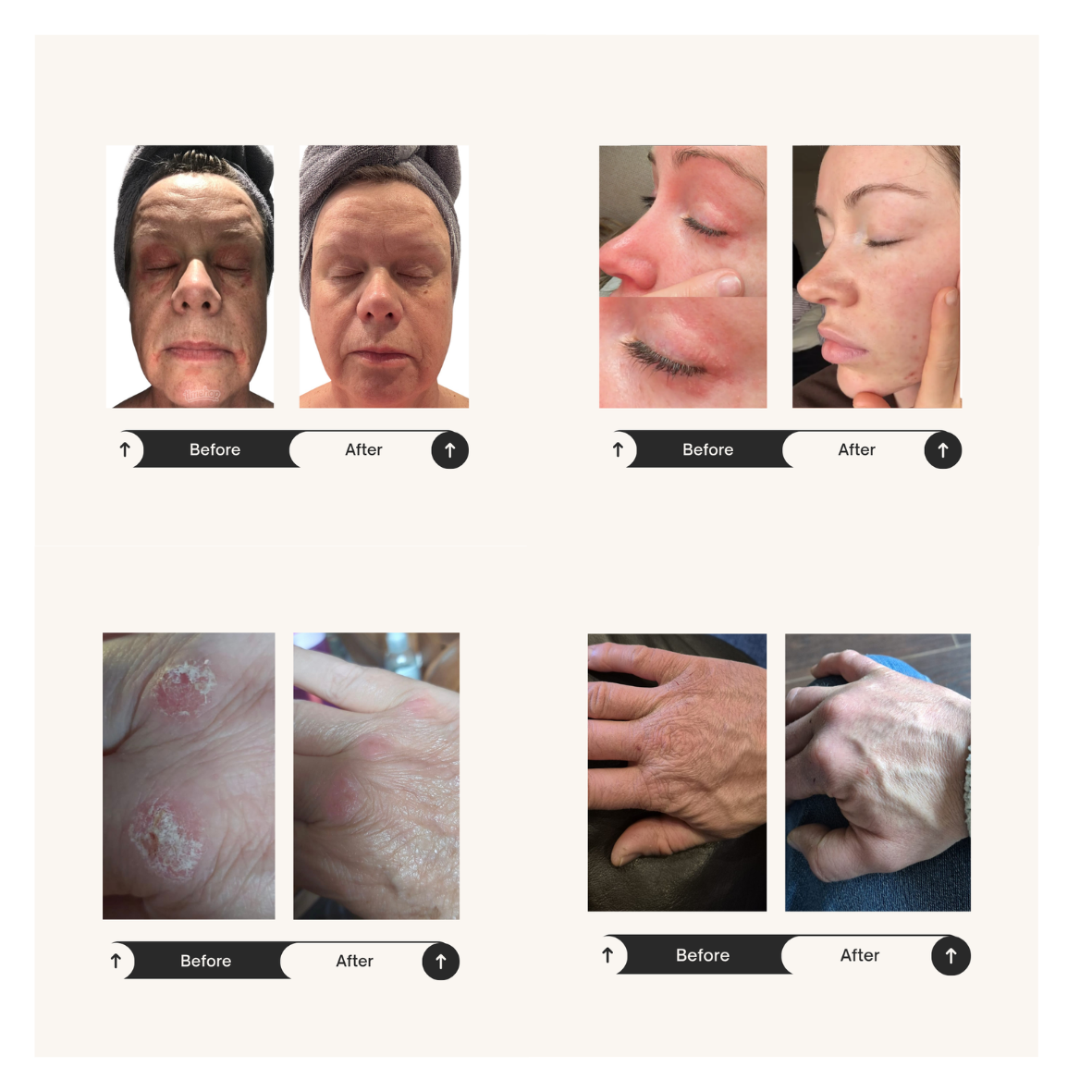 ReCalm Beauty Balm, the best barrier balm for dry skin psoriasis, dermatitis and rosacea