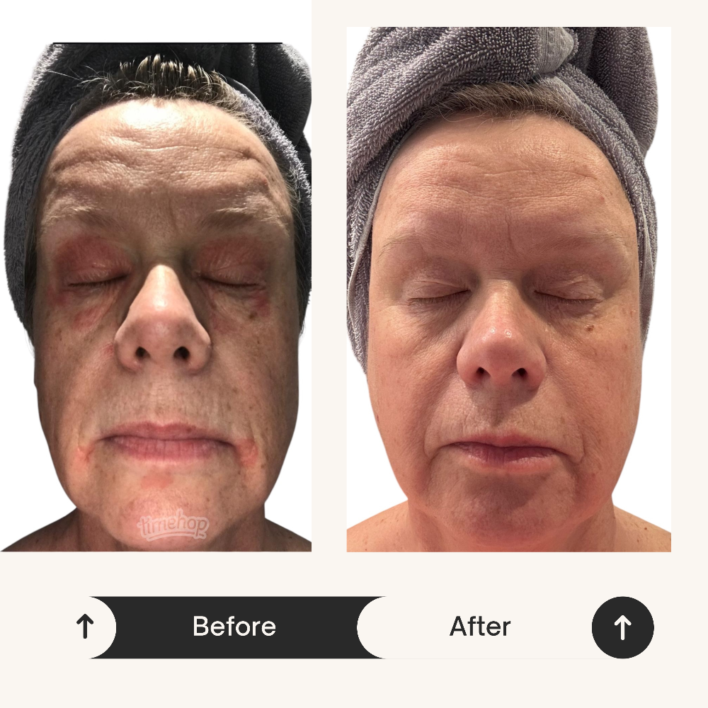 Before and after photo of Karen using ReCalm Beauty Balm as an eye cream, cleanser, and soothing night balm for allergy-prone skin.