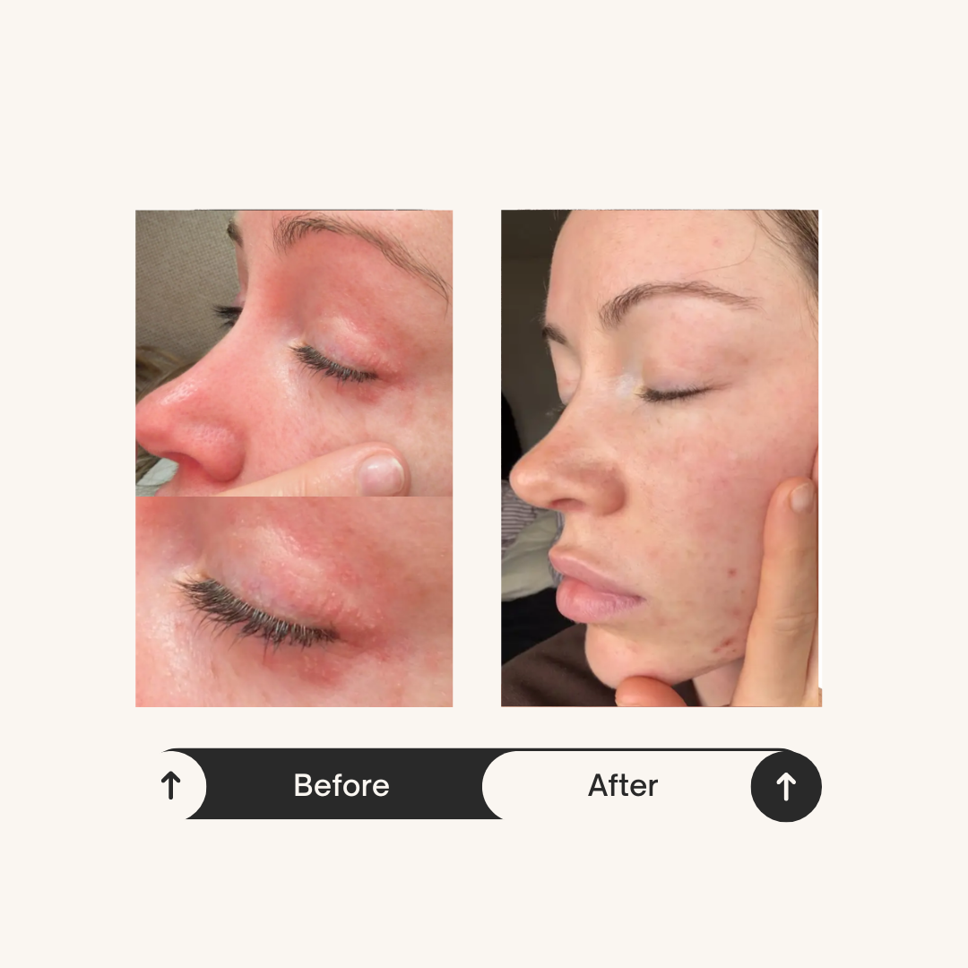 Before and after skin transformation results from Rosie using ReCalm Beauty Balm as a natural makeup primer and daily treatment for glowing skin. 