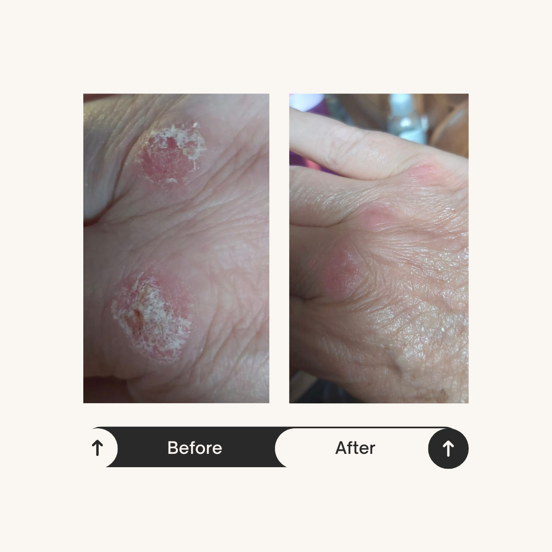 Before and after photo of June using ReCalm Beauty Balm as a pre-shower skin barrier to protect skin prone to psoriasis from water irritation